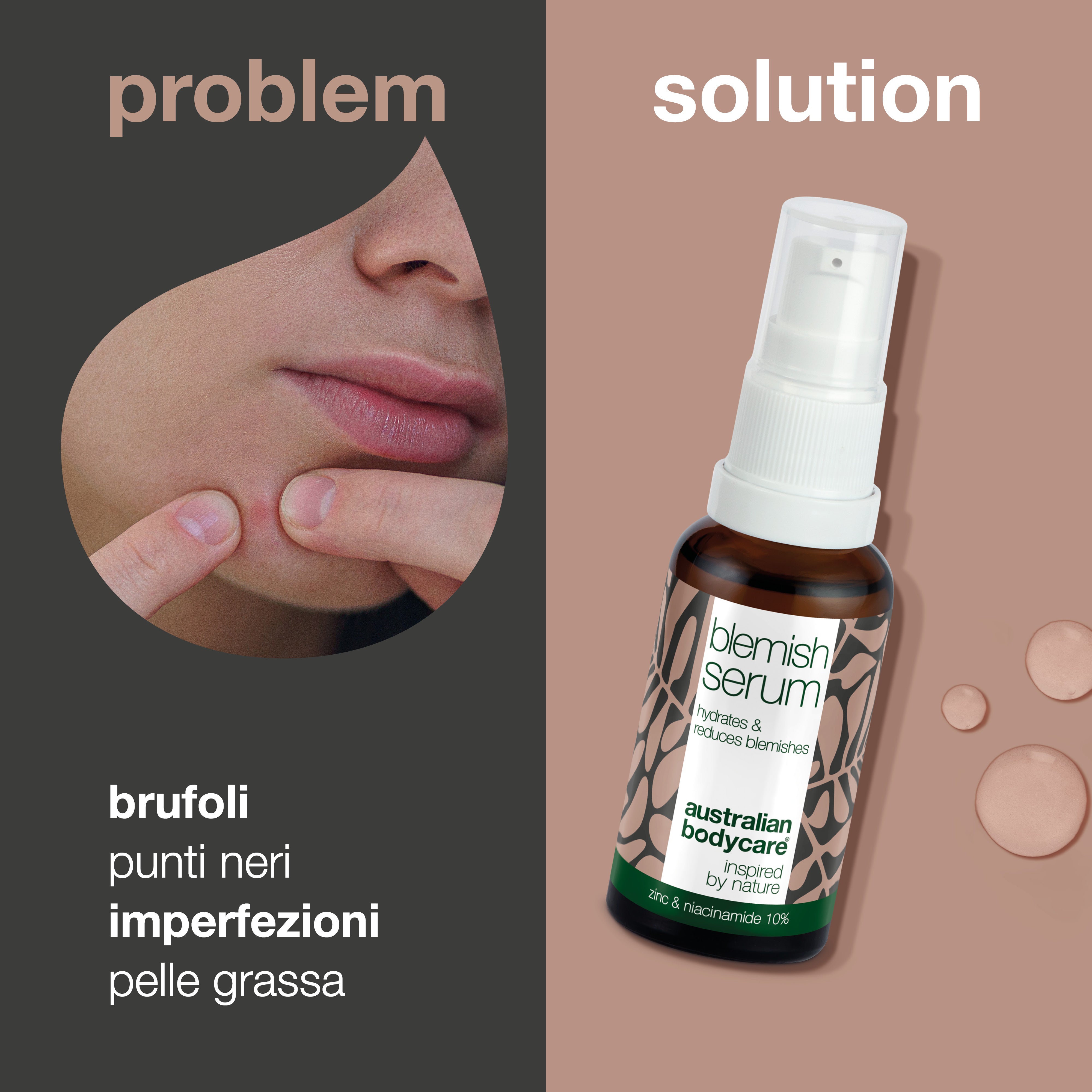 Siero alla niacinamide per brufoli e pelle congestionata - Con il 10% di niacinamide, l'1% di zinco e olio dell'albero del tè per brufoli, punti neri e imperfezioni