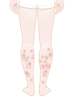 Psoriasi - Buone opzioni per prevenzione e trattamento