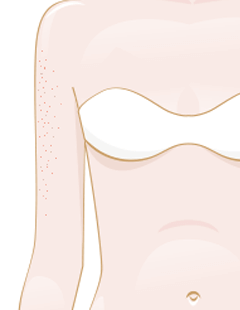 Punti Bianchi - Cosa sono e come posso liberarmene? 