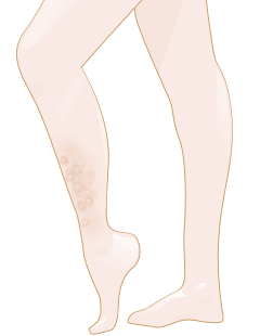 Funghi della pelle - perché si manifesta e cosa si può fare?