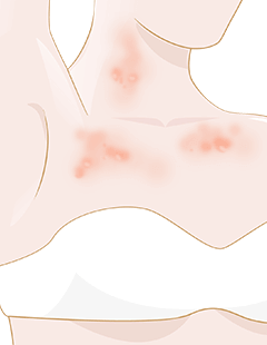 Tipi di Eczema - Come trattare efficacemente e rapidamente l'eczema