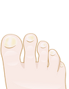 micosi unghie piedi tea tree oil