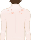 micosi 