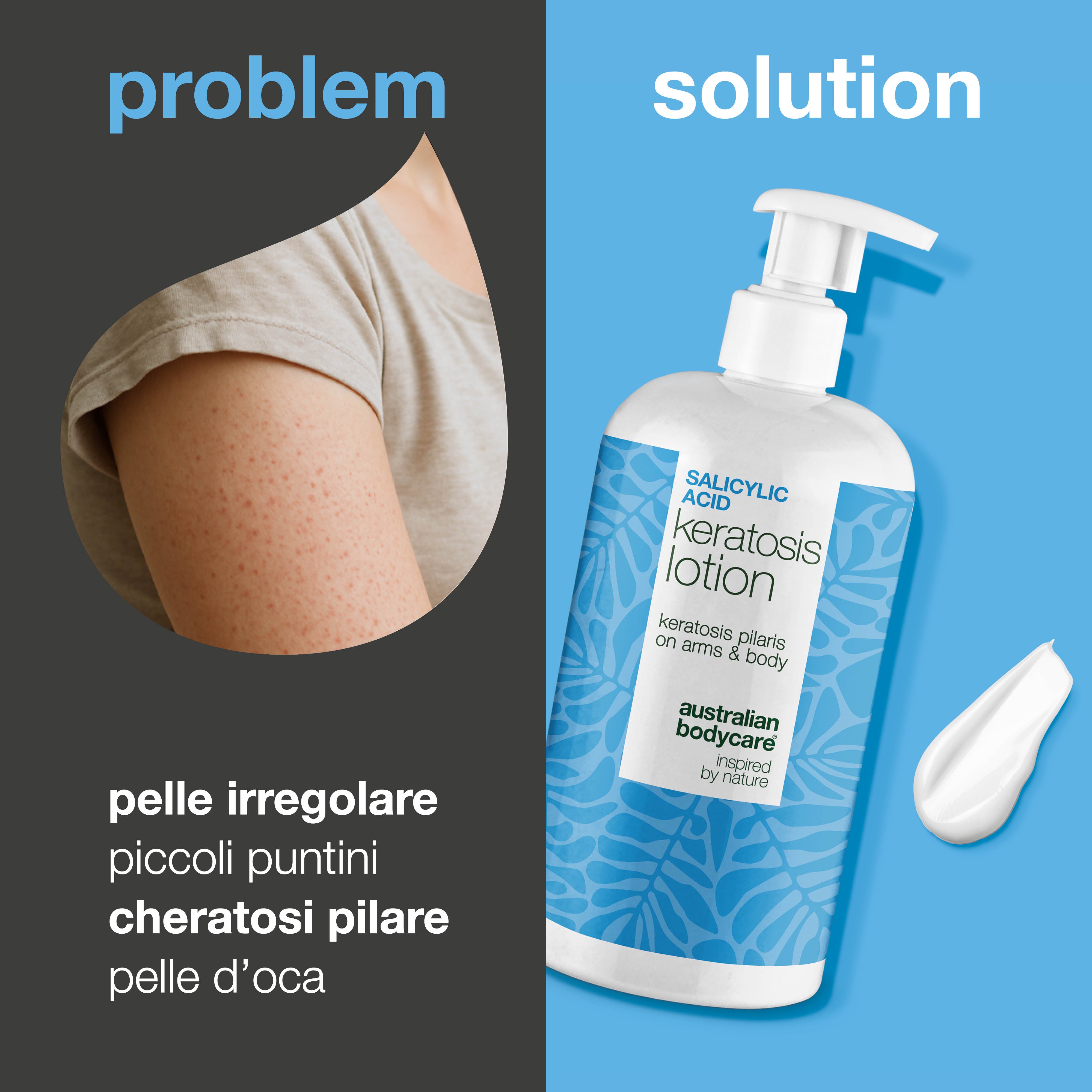 Body lotion per cheratosi pilare e pelle secca e ruvida — Body lotion per cheratosi pilare e secchezza. Con acido salicilico, niacinamide e zinco per una pelle più liscia.