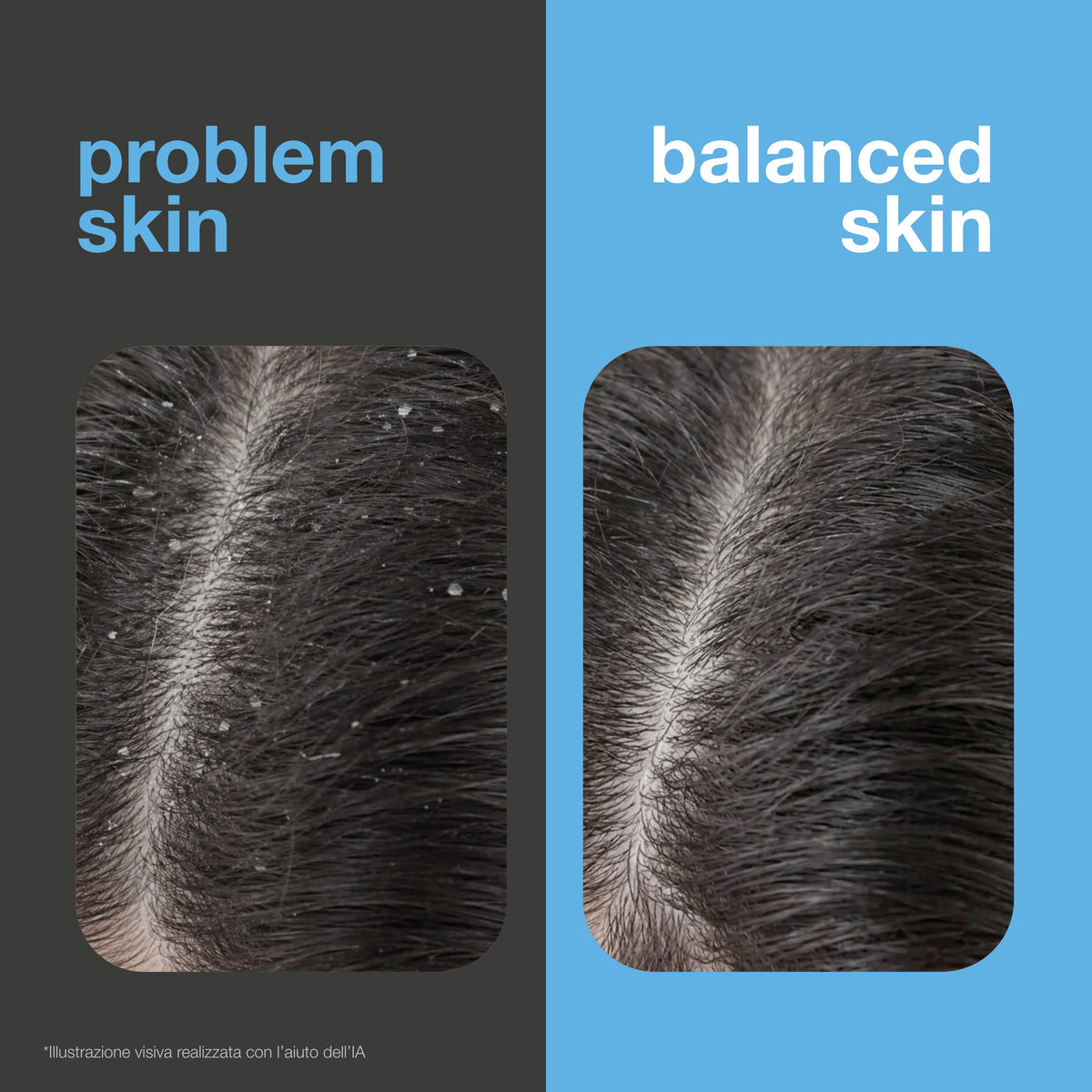 Prima e dopo: cuoio capelluto con forfora visibile rispetto a un cuoio capelluto senza forfora ed equilibrato. Illustrazione visiva.