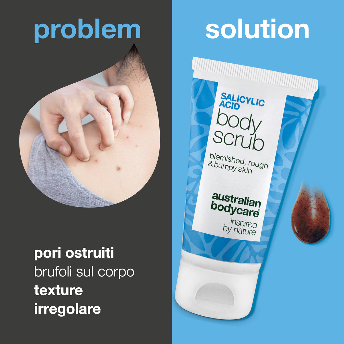 Problema e soluzione: brufoli sul corpo, pori ostruiti e pelle irregolare. A sinistra un primo piano di una spalla con brufoli, a destra lo Salicylic Acid Body Scrub di Australian Bodycare