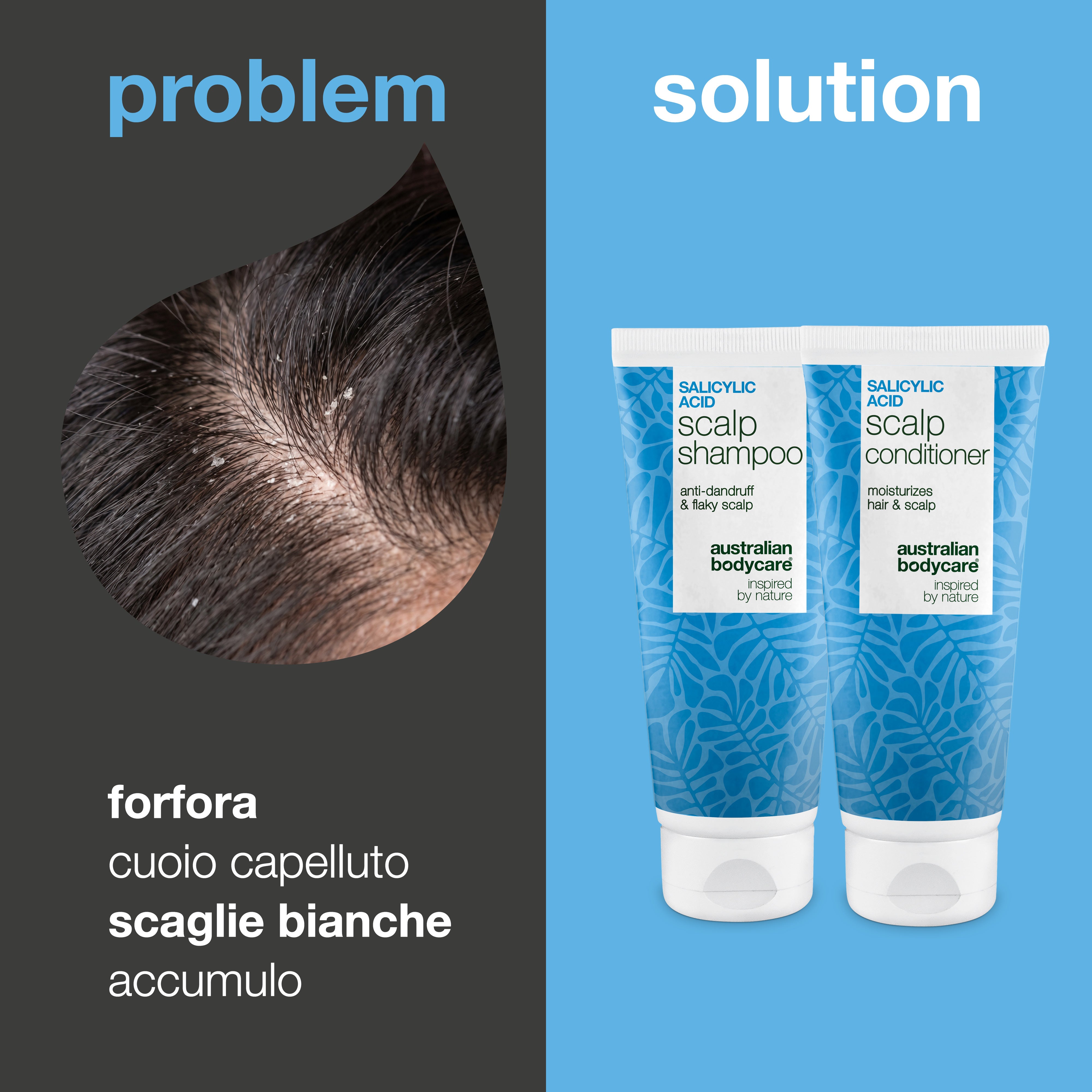 Problema e soluzione: primo piano di forfora e scaglie bianche sul cuoio capelluto accanto a shampoo e balsamo del kit