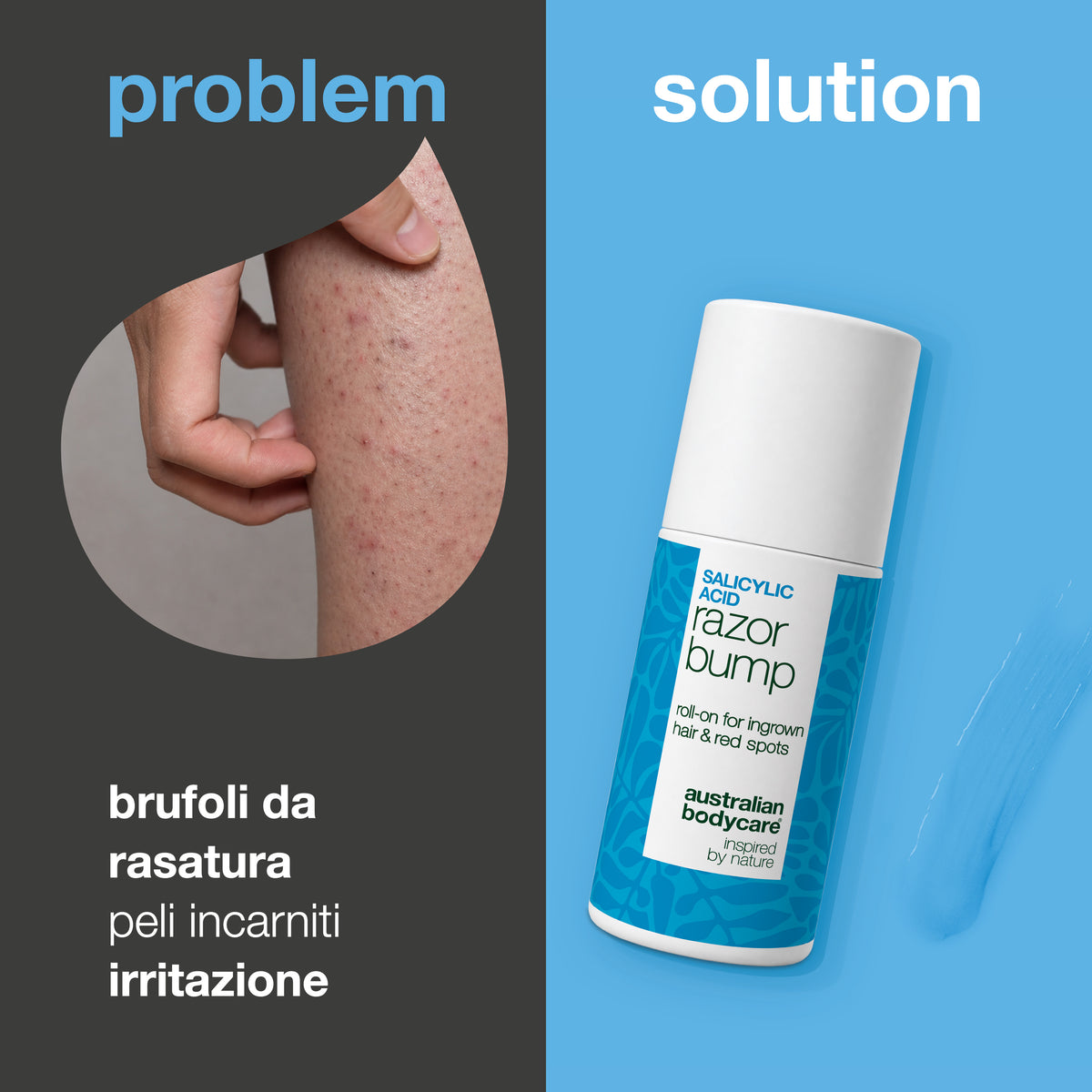 Problema e soluzione: brufoli da rasatura, peli incarniti e irritazione. A sinistra un primo piano di una mano che pizzica una coscia con brufoletti rossi, a destra un roll-on Salicylic Acid Razor Bump di Australian Bodycare.