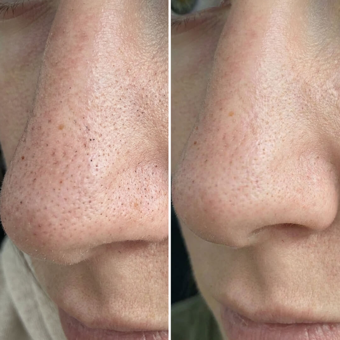 Kit contro punti neri e pori ostruiti con acido salicilico – routine purificante per una pelle liscia