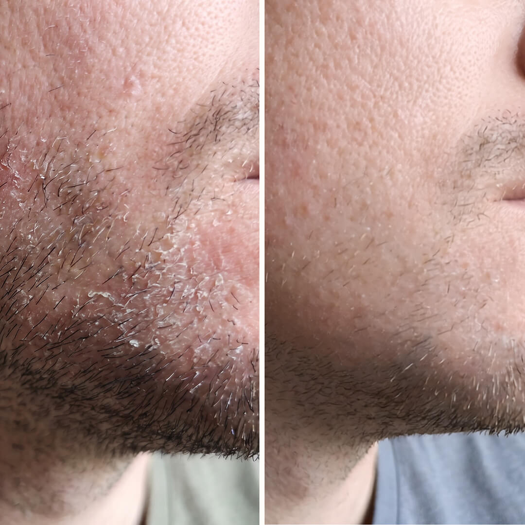 Siero Acido Salicilico – Contro forfora viso e barba — Siero efficace contro la forfora del viso e della barba. L'Acido Salicilico rimuove squame e rossori per un incarnato sano e bilanciato.