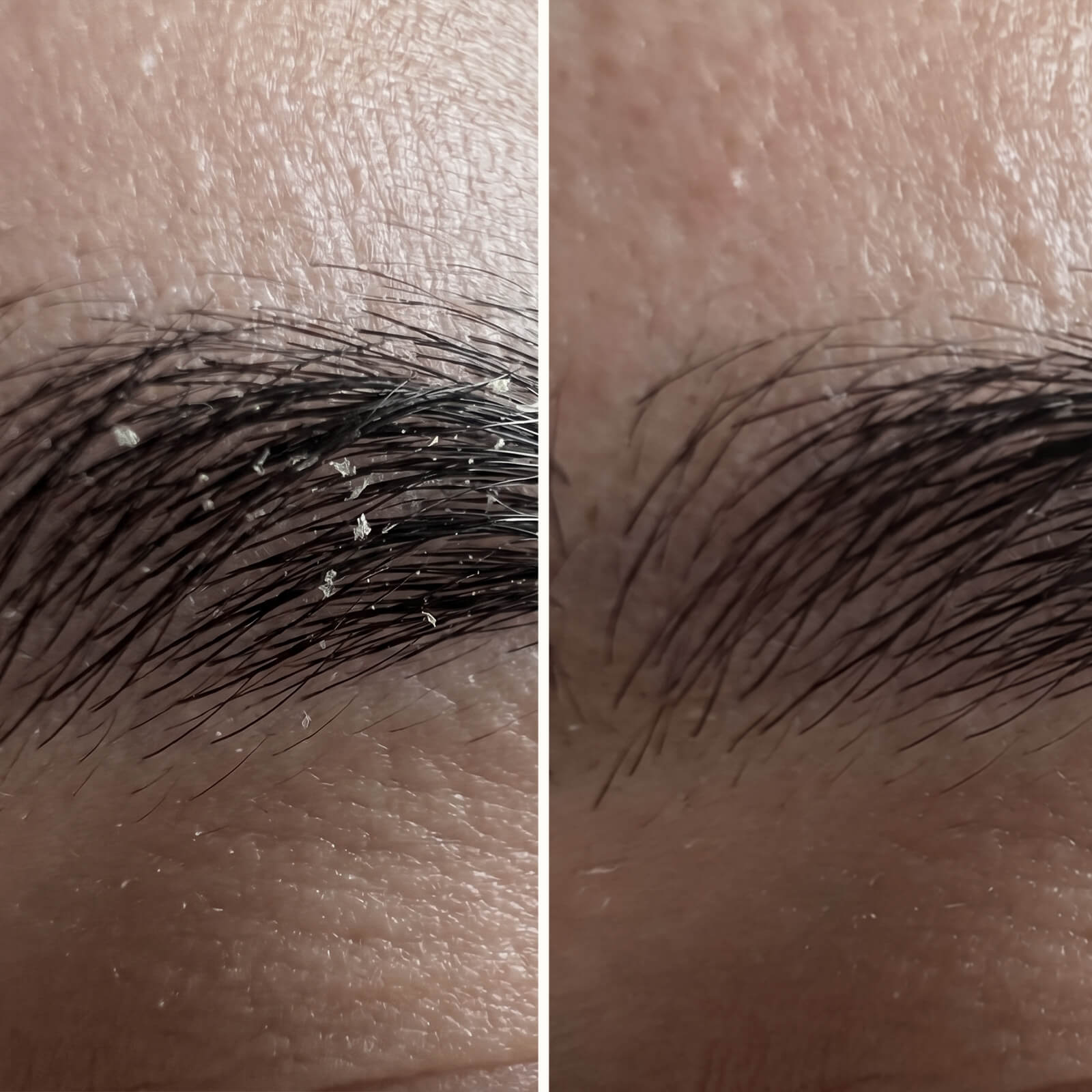 Siero Acido Salicilico – Contro forfora viso e barba — Siero efficace contro la forfora del viso e della barba. L'Acido Salicilico rimuove squame e rossori per un incarnato sano e bilanciato.