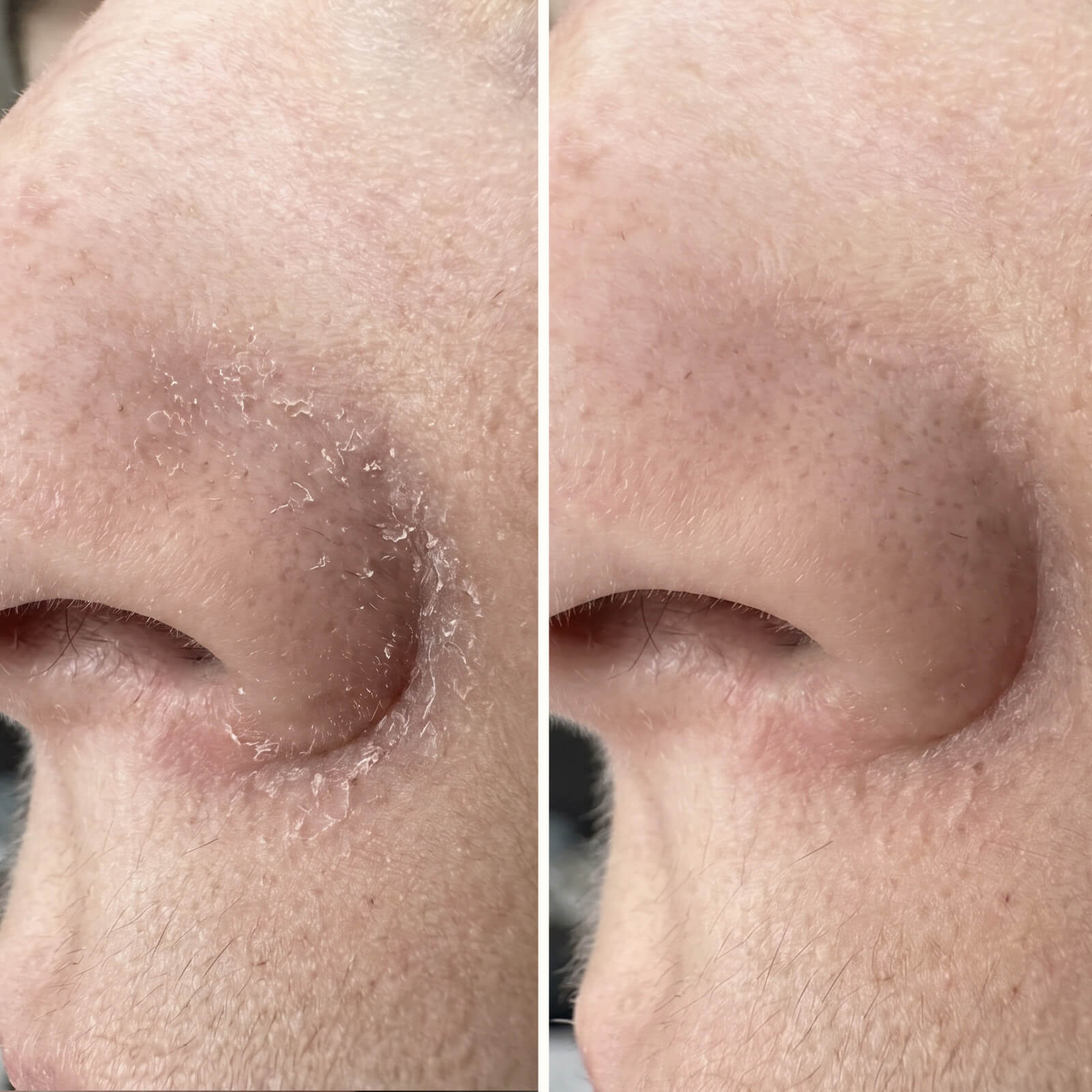 Siero Acido Salicilico – Contro forfora viso e barba — Siero efficace contro la forfora del viso e della barba. L'Acido Salicilico rimuove squame e rossori per un incarnato sano e bilanciato.