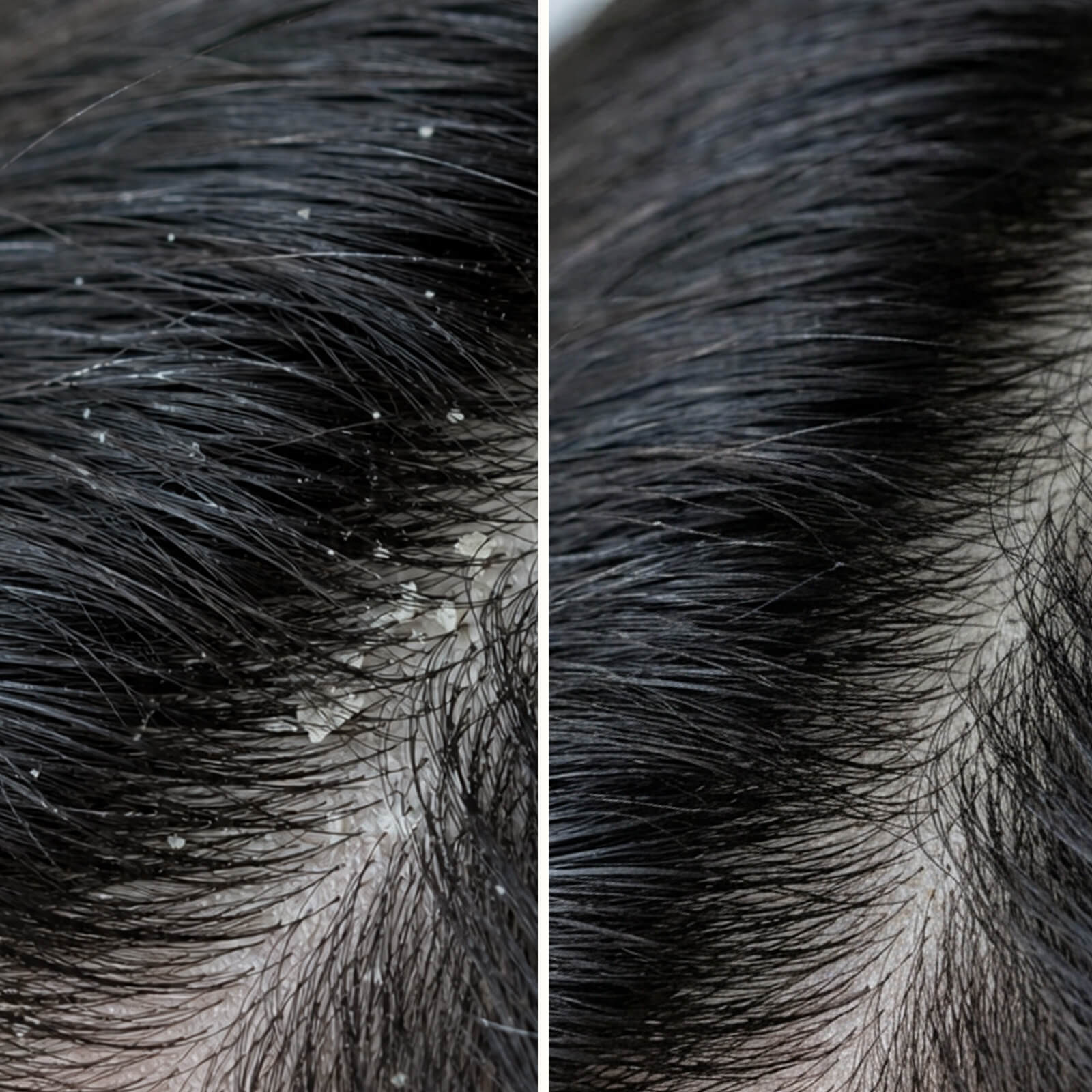 Shampoo Acido Salicilico per Forfora e Prurito — Addio a prurito e forfora con questo shampoo. Lenisce la pelle secca ed elimina le cellule morte con acido salicilico.