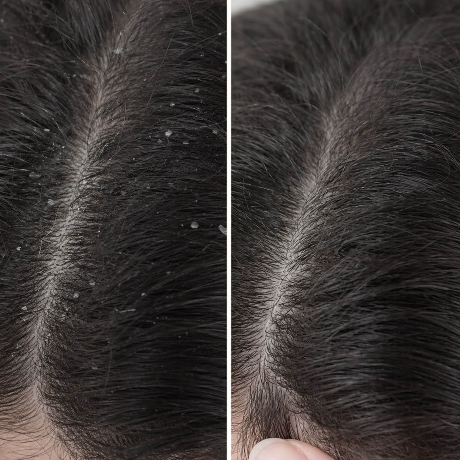Balsamo Acido Salicilico contro forfora e prurito alla cute — Balsamo all'Acido Salicilico contro forfora e irritazioni. Idrata la cute e rinforza i capelli. Trattamento efficace con Acido Salicilico.