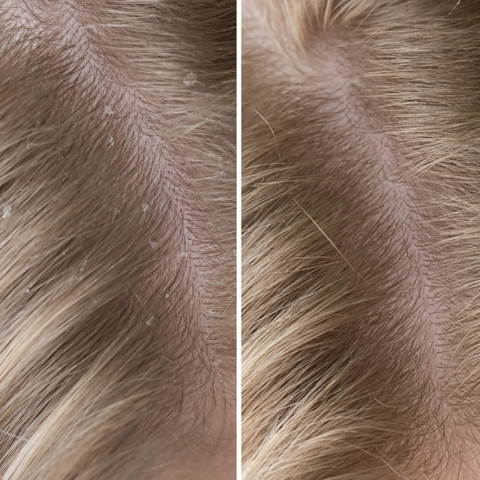 Shampoo Acido Salicilico per Forfora e Prurito — Addio a prurito e forfora con questo shampoo. Lenisce la pelle secca ed elimina le cellule morte con acido salicilico.