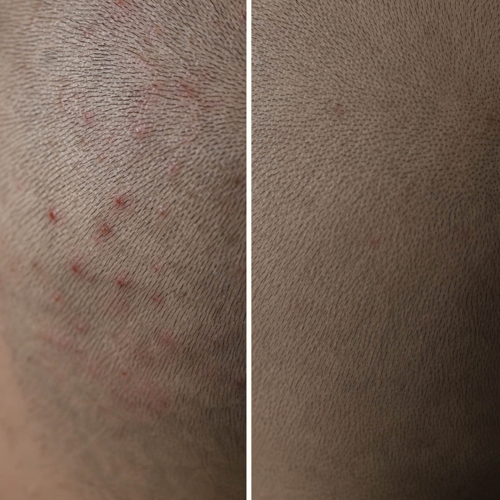 Gel Acido Salicilico per Brufoli e Prurito in Testa — Stop ai brufoli sul cuoio capelluto! L'Acido Salicilico esfolia i pori, riduce l'olio e lenisce i punti rossi e dolorosi in modo naturale.