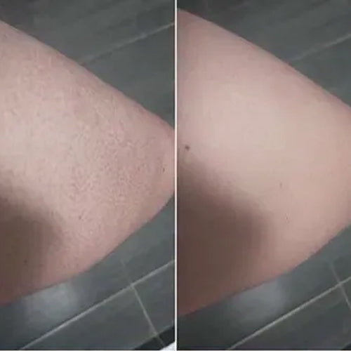 Cheratosi pilare prima e dopo di Alena – pelle più liscia dopo 2 settimane