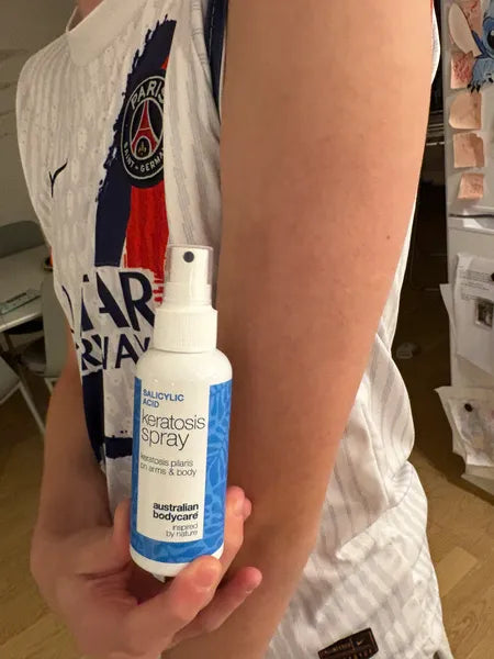 Risultato cheratosi pilare – 70% de réduction des boutons après 3 semaines