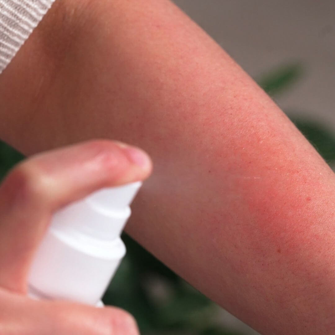 Spray anti prurito lenitivo e calmante il corpo — per lenire la pelle affetta da prurito o irritazione