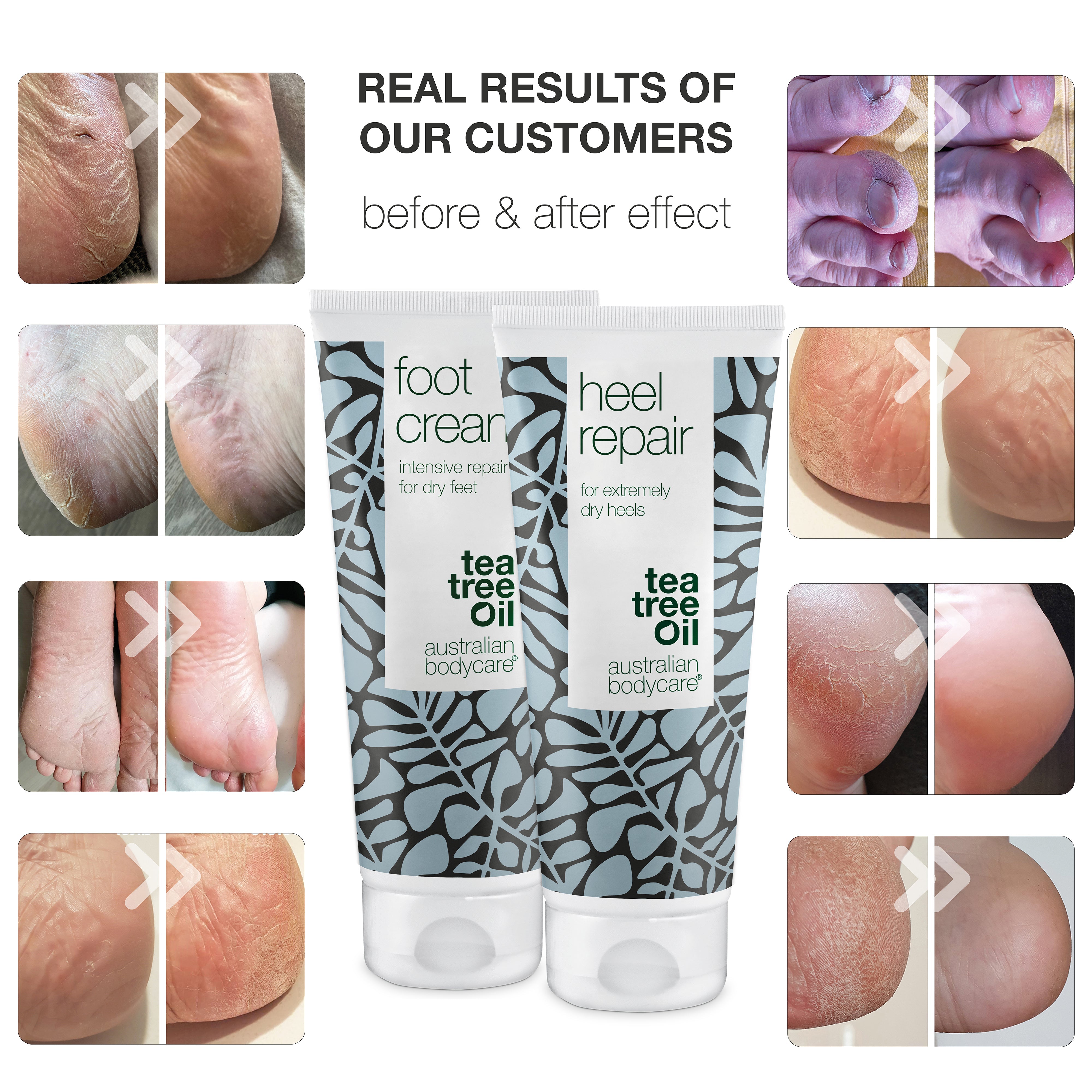2 prodotti per piedi e talloni secchi — Crema piedi e crema per talloni con urea e Tea Tree Oil, per piedi secchi e talloni screpolati